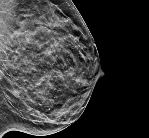 Hologic C-View™ gesynthetiseerde 2D-beeldvorming op witte achtergrond