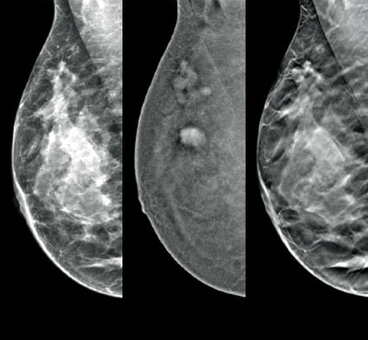 Hologic Hologic I-View™ contrastversterkte beeldvorming
