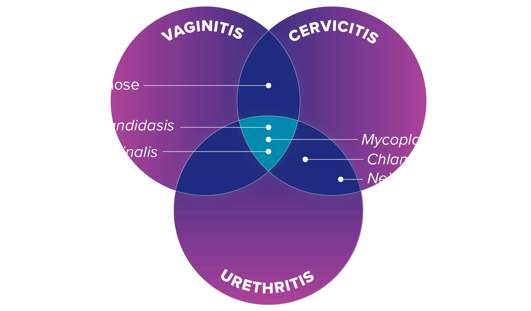Overlappende illustratie van Vaginitis Cervicitis Urethritis
