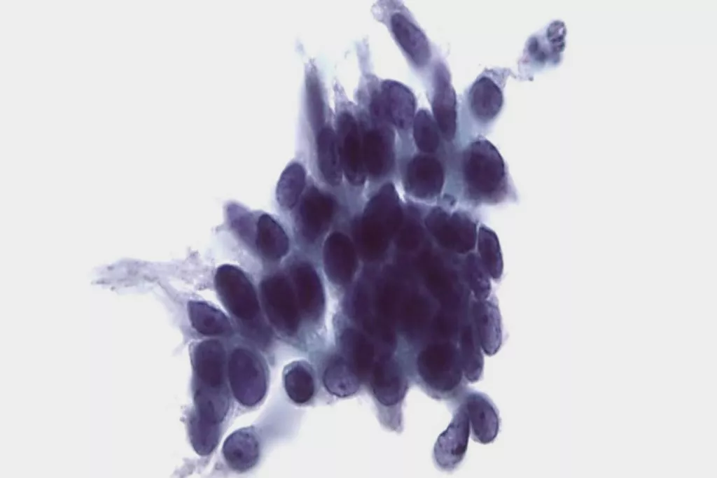 Cervicale glandulaire intraepitheliale neoplasie op Pap-testscan