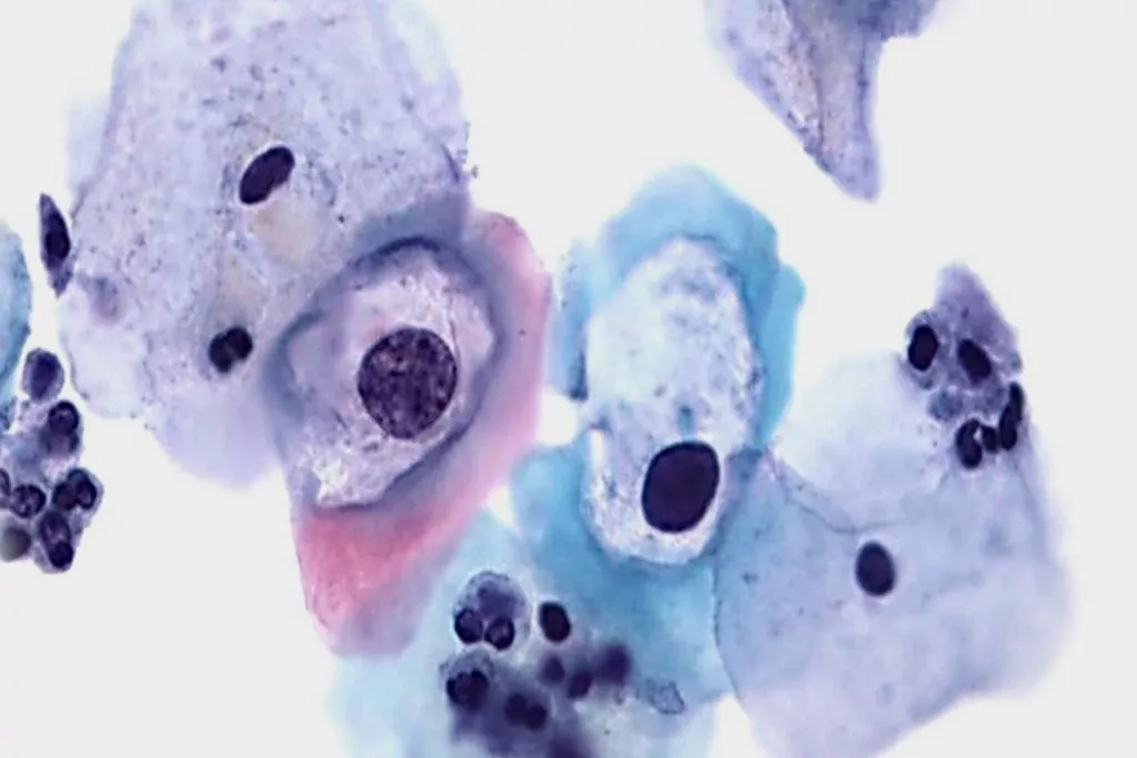 Laaggradige dyskaryose met HPV op Pap-testscan