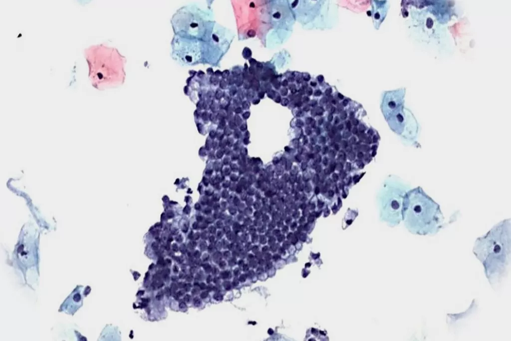 Pap-testscan negatief met endocervicale cellen