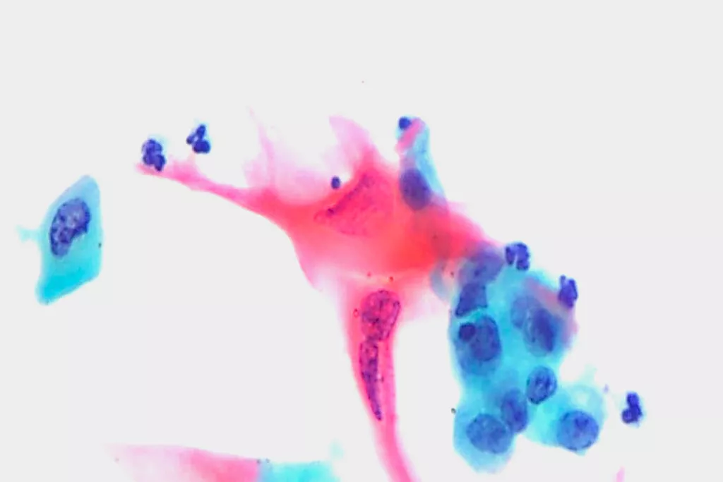 Plaveiselcelcarcinoom, urine, Papanicolaou-kleuring