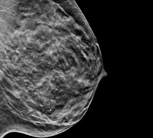 Hologic C-View™ gesynthetiseerde 2D-beeldvorming op witte achtergrond