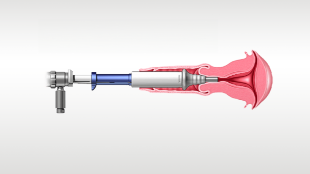 Illustratie van medisch hulpmiddel in gebruik.