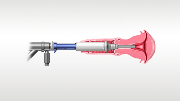 Illustratie van medisch hulpmiddel in gebruik.